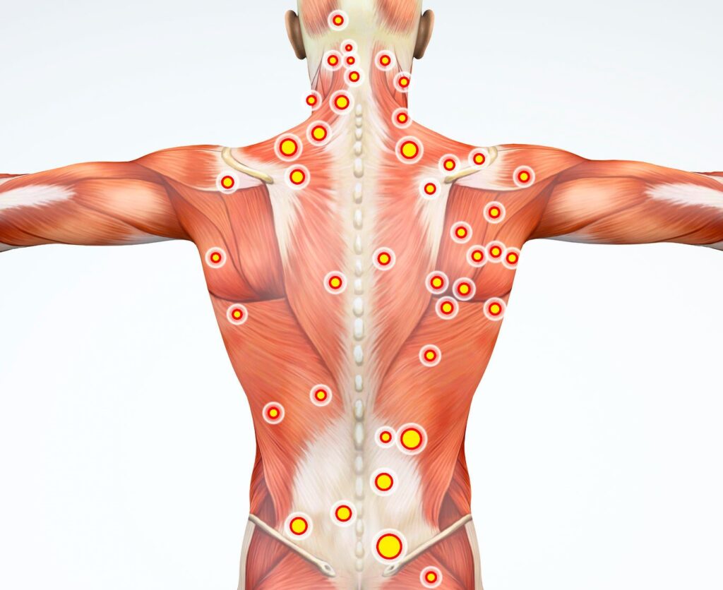 Trigger Points and Myofascial Pain Syndrome