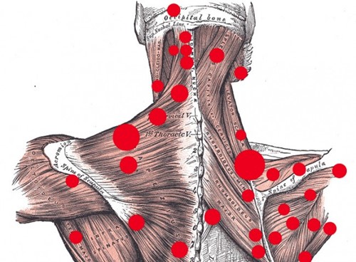 3 Types of Trigger Points